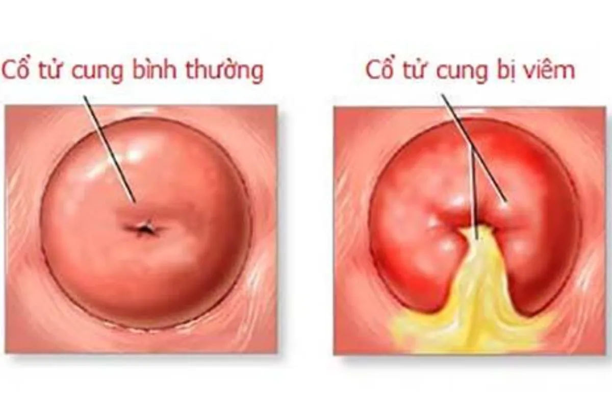 Viêm cổ tử cung