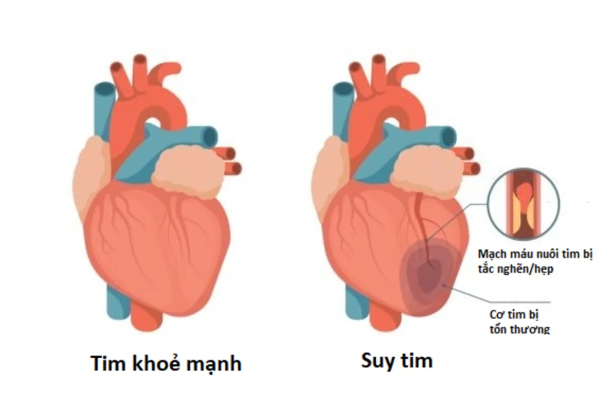 Các dấu hiệu nhận biết suy tim