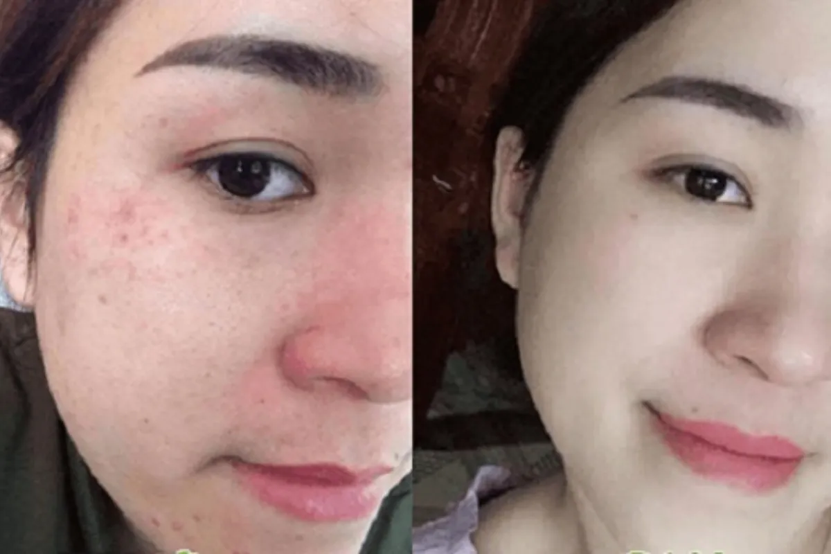 Đối tượng nên tránh sử dụng retinol