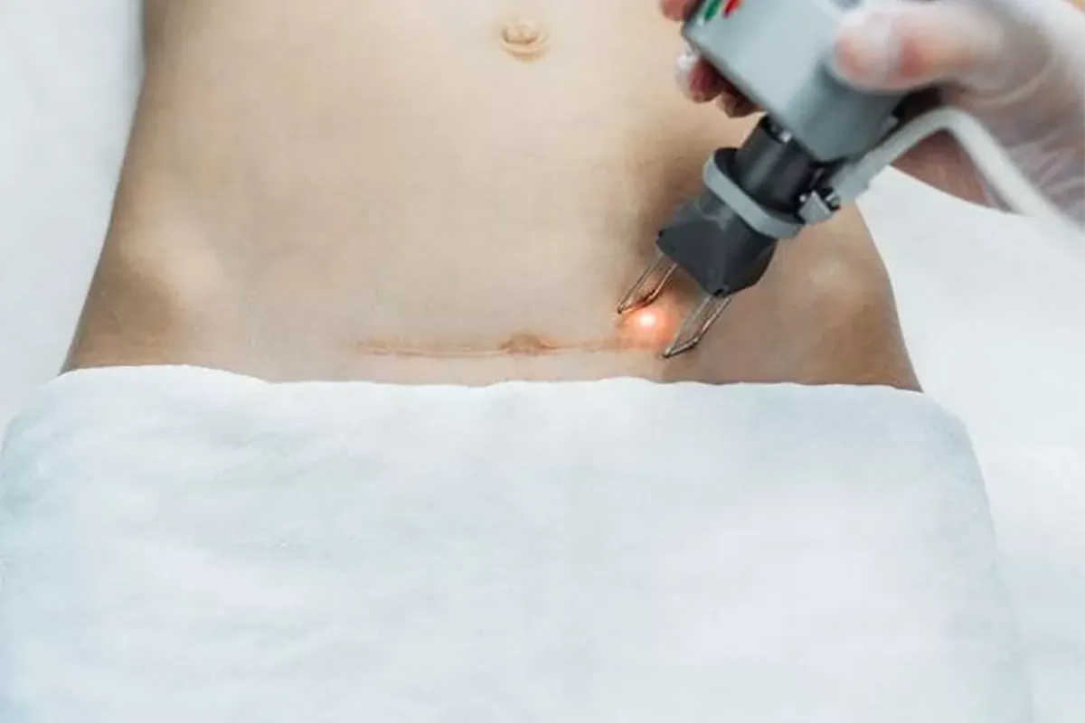 Liệu pháp laser