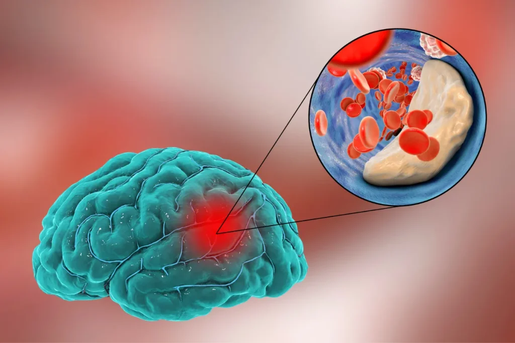 Thiếu máu não là gì? Nguyên nhân, triệu chứng và cách điều trị